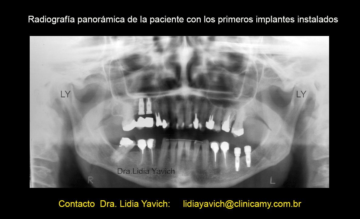 10B PANORAMICA implantes 1